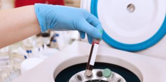 PRP for stretch marks